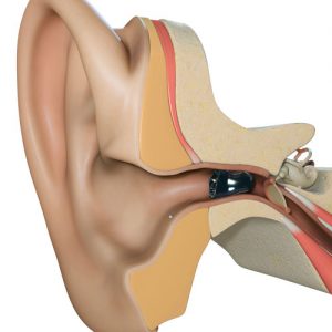 Invisible In Canal (IIC) Hearing Aids 3 invisible-in-the-canal-hearing aid shown-in-ear